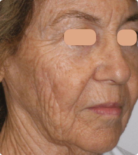 Before treatment